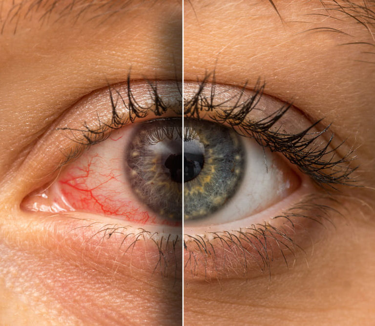 aldrig Irreplaceable mentalitet Why Are My Eyes Red & Bloodshot? | Causes and Treatment | Ocuwellness