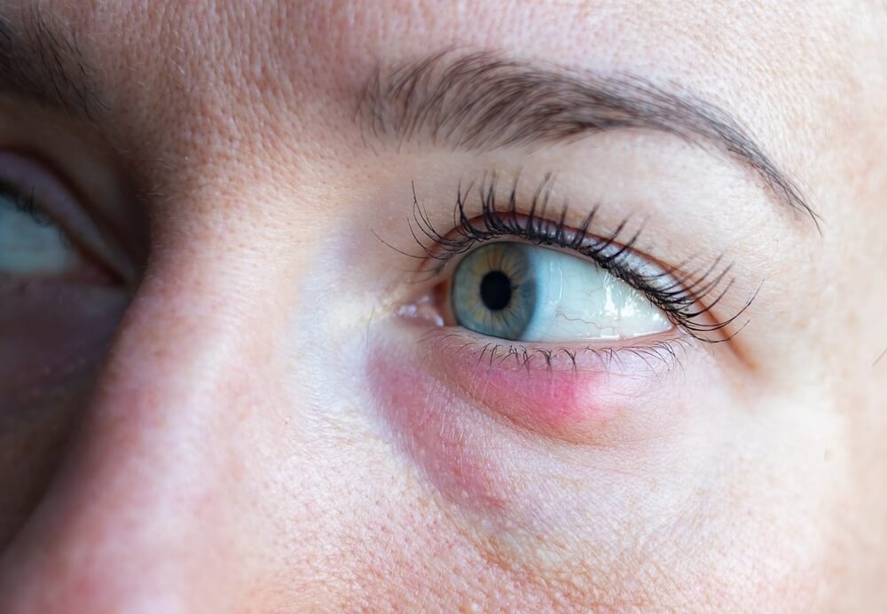 Styes | Symptoms, Causes and Treatment | OcuWellness
